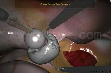 卵巢囊肿切除术模拟系统
